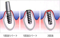 �C���v�����g�̏p��