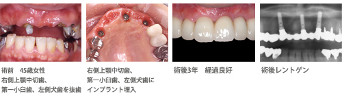 �C���v�����g�̖���