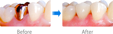 �Z���b�N���� Before-After