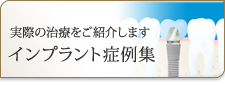 インプラント症例実例