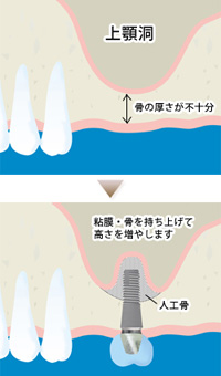 サイナスリフト