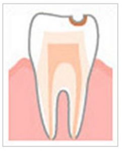 少し進行した虫歯