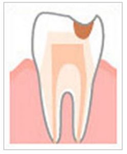 象牙質が溶けた虫歯