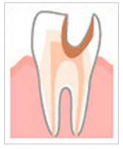 神経に達した虫歯