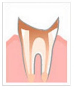根元だけ残った虫歯