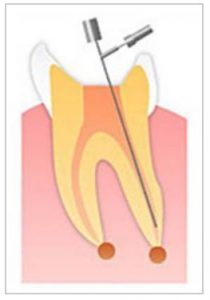 根管治療