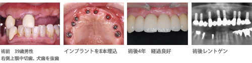 インプラント症例