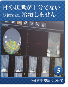 インプラント治療を成功させるための６つのポリシー