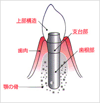 インプラントとは