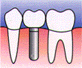 インプラント