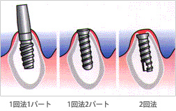 インプラントの術式