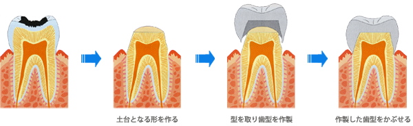 神経の治療をせず、かぶせた場合