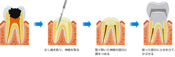 神経の治療をして、かぶせた場合