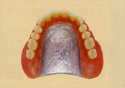 上の総入れ歯 - コバルトクローム合金