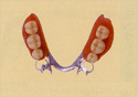 部分入れ歯 - コバルトクローム合金