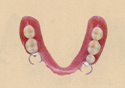 部分入れ歯 - プラスチック