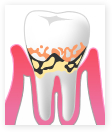 軽度歯周炎の様子