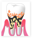 重度歯周炎の様子