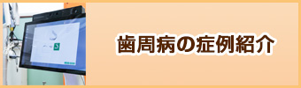 歯周病の症例紹介